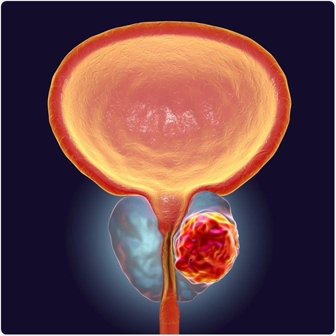 What Percent Of Prostate Lesions Are Cancerous Bobby Vincent S Blog